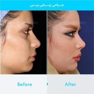 rhinoplasty-114