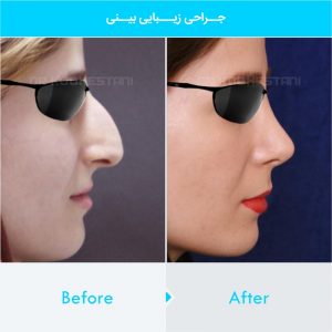 rhinoplasty-119