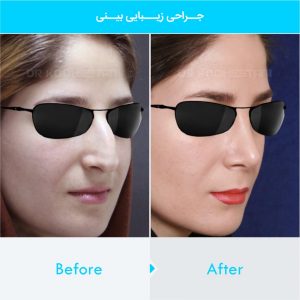 rhinoplasty-120