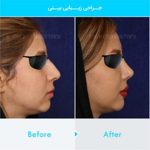 rhinoplasty-122