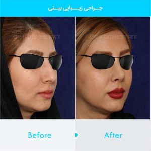 rhinoplasty-123