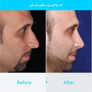 rhinoplasty-125