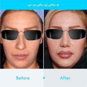 rhinoplasty-127