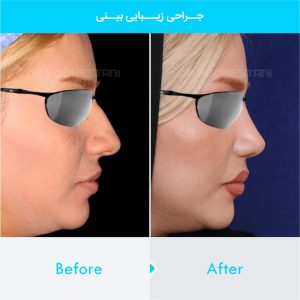 rhinoplasty-128