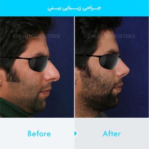 rhinoplasty-135