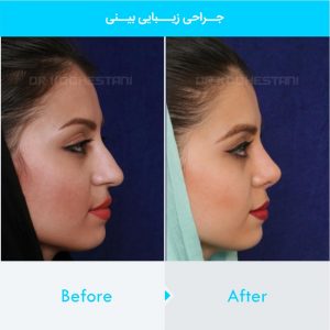 rhinoplasty-140