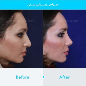 rhinoplasty-143