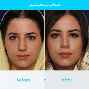 rhinoplasty-145