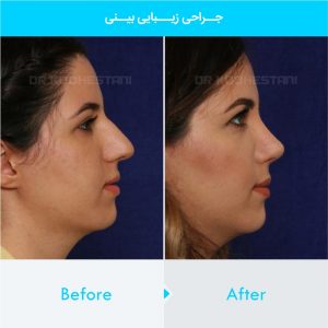 rhinoplasty-146