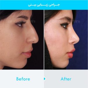 rhinoplasty-149