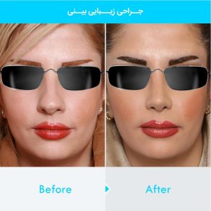 rhinoplasty-150