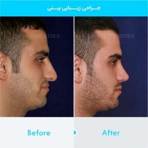 rhinoplasty-154