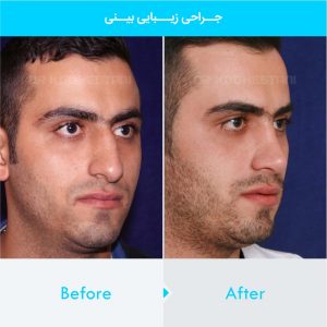 rhinoplasty-155