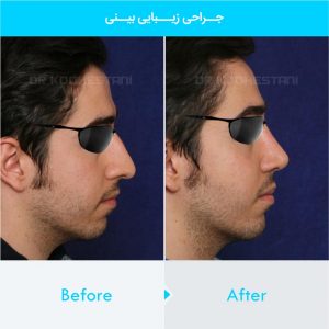 rhinoplasty-157