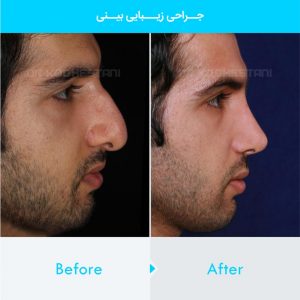 rhinoplasty-159