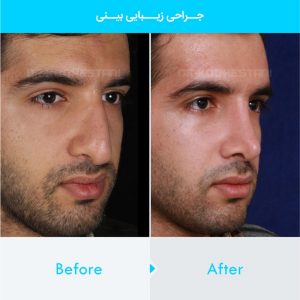 rhinoplasty-160