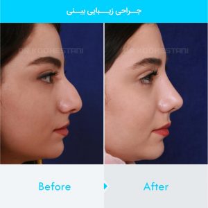 rhinoplasty-162