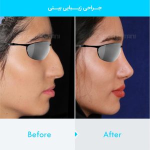 rhinoplasty-165