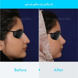 rhinoplasty-167