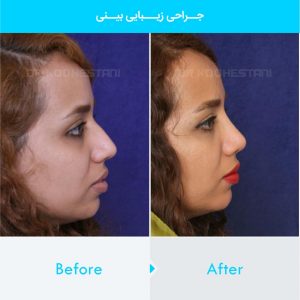 rhinoplasty-170