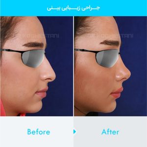 rhinoplasty-173