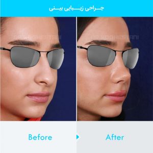 rhinoplasty-174