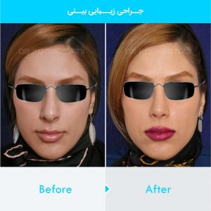 rhinoplasty-175