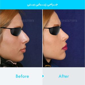 rhinoplasty-176