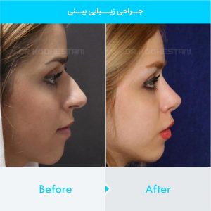 rhinoplasty-179