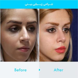 rhinoplasty-180