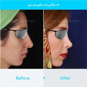 rhinoplasty-182