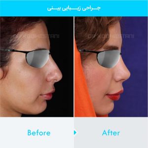 rhinoplasty-185