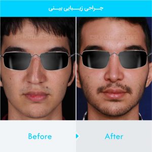 rhinoplasty-187