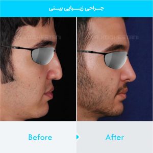 rhinoplasty-188