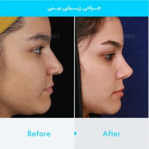 rhinoplasty-190