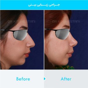 rhinoplasty-199