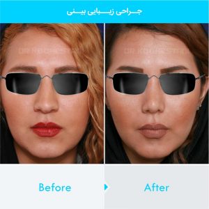 rhinoplasty-200