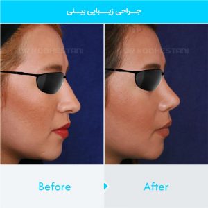 rhinoplasty-201