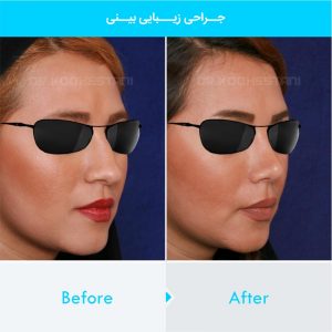 rhinoplasty-202