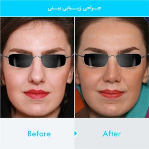 rhinoplasty-203