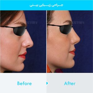 rhinoplasty-204