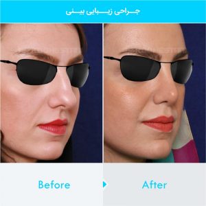 rhinoplasty-205