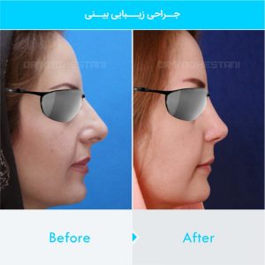 rhinoplasty-207