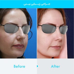 rhinoplasty-208