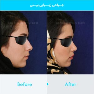 rhinoplasty-210