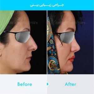 rhinoplasty-213