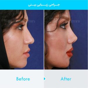 rhinoplasty-215