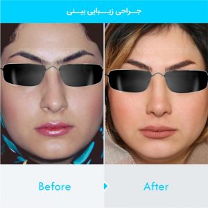 rhinoplasty-217