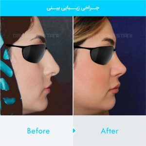 rhinoplasty-218