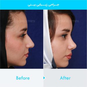 rhinoplasty-220